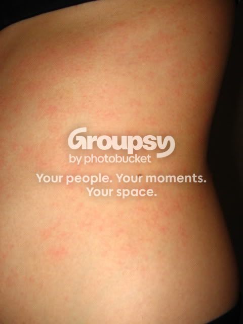 Rash | Crohn's Disease Forum